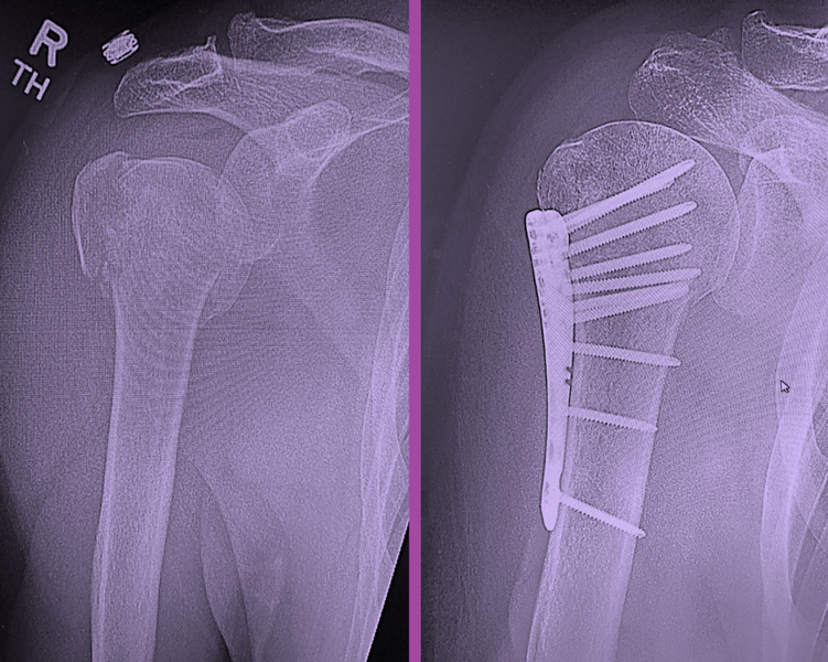 File:Proximal humeral fracture and fixation (Medium).png
