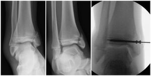Figure 7: Salter-Harris IV fracture of the distal tibia fracture showing the fracture line traveling through the metaphysis, through the physis, and into the epiphysis exiting in the ankle joint. Treated with open reduction and cannulated screw fixation.