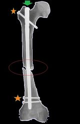 Figure 6: A femoral IM nail. The nail is inserted via a hole drilled in the proximal femur (green arrow) such that the soft tissue around the fracture site (red circle) is not disturbed. Locking screws (orange stars) are then inserted to control the length and rotation of the femur.
