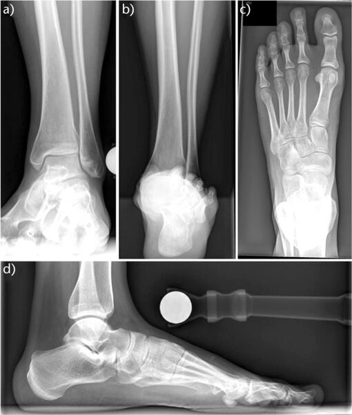 File:Foot and Ankle Radiograph Normal.jpg