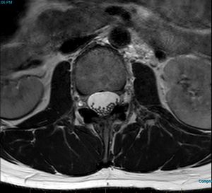 MRI T2 Lumbar Spine L2 Subpedicular Axial.jpg