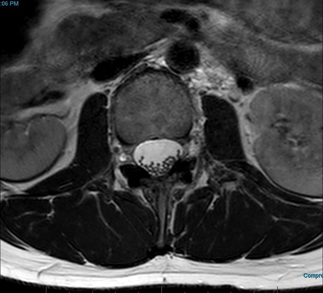 File:MRI T2 Lumbar Spine L2 Subpedicular Axial.jpg