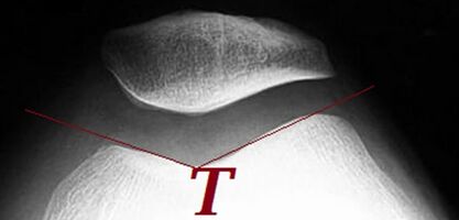 Figure 2: A sunrise view of the patella, showing the patella sitting within the trochlear groove of the anterior distal femur (T). (From http://www.wikiradiography.net/page/the+skyline+patella+projection)