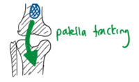 Patellar Tracking.PNG
