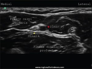 Ultrasound Ulnar Nerve.png