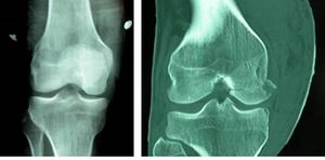Figure 5: A Hoffa fracture of the medial femoral condyle, as seen on radiographs (left) and coronal CT imaging (right). (Image courtesy of Samba Kone et al. Hoffa fracture of medial unicondylar and bilateral in a man: a rare case. Pan African Medical Journal. 2015;20:382. [doi: 10.11604/pamj.2015.20.382.6092])