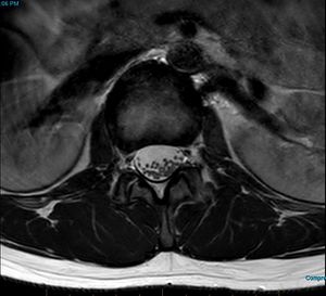 MRI T2 Lumbar Spine L1-L2 Transarticular Axial.jpg