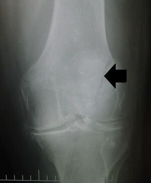 Patellar non displaced vertical fracture.jpg