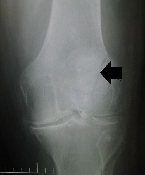 File:Patellar non displaced vertical fracture.jpg