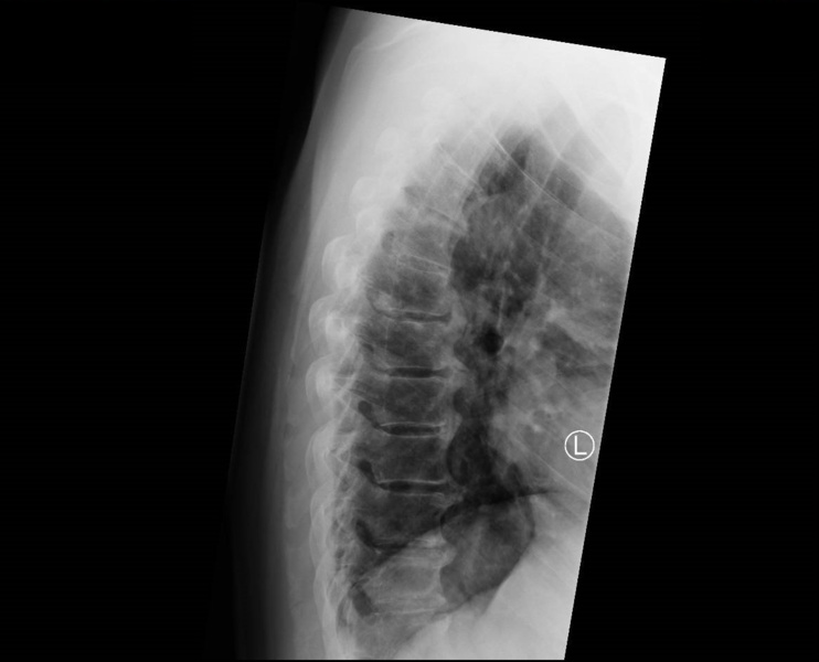 File:DISH Thoracic Lateral.png