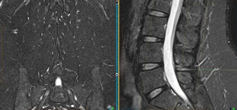 MRI T2 coronal Dixon and sagittal images showing interspinous oedema at the L4/5 interspace.