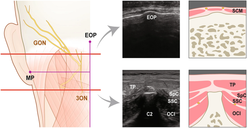 File:GON and TON ultrasound.png