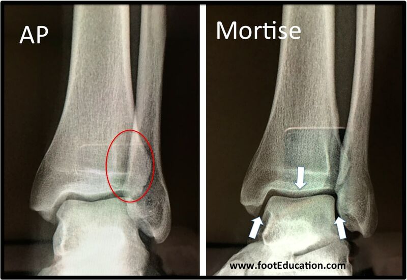 File:Mortise view ankle.jpg